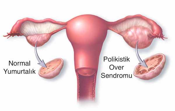 Polikistik Over Sendromu ve Diğer Hormon Bozuklukları Tedavisi